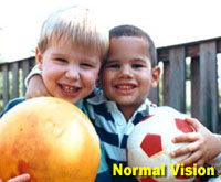 Cataract1