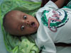 Hydrocephalus-before-VP-sm Hydrocephalus-before-VP-sm