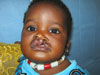 unilateral-left-cleft-lip-S unilateral-left-cleft-lip-S