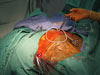 VP-shunt-placement-sm VP-shunt-placement-sm