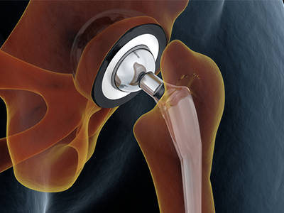 Joint replacement_social Joint replacement_social