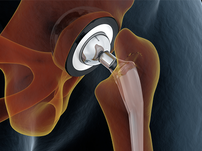 Joint replacement_social