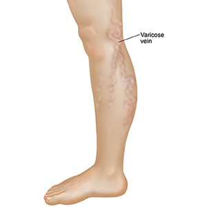 Varicose-Vein-for-web Varicose-Vein-for-web