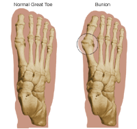 bunion bunion